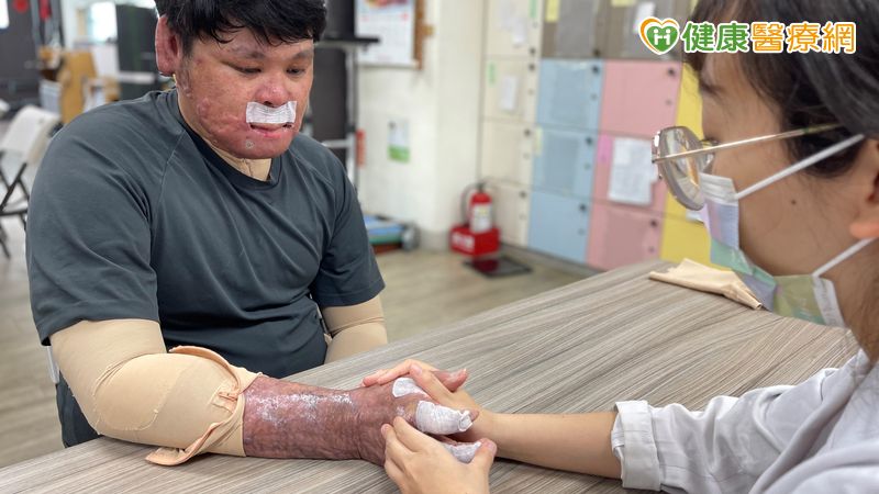 70%嚴重燒傷!30歲青年忍「皮膚撕裂」復健劇痛 半年重拾自主力
