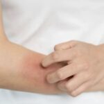 麻疹入侵苗栗！30多歲女泰國入境染疫　匡列112人監測中「足跡一次看」